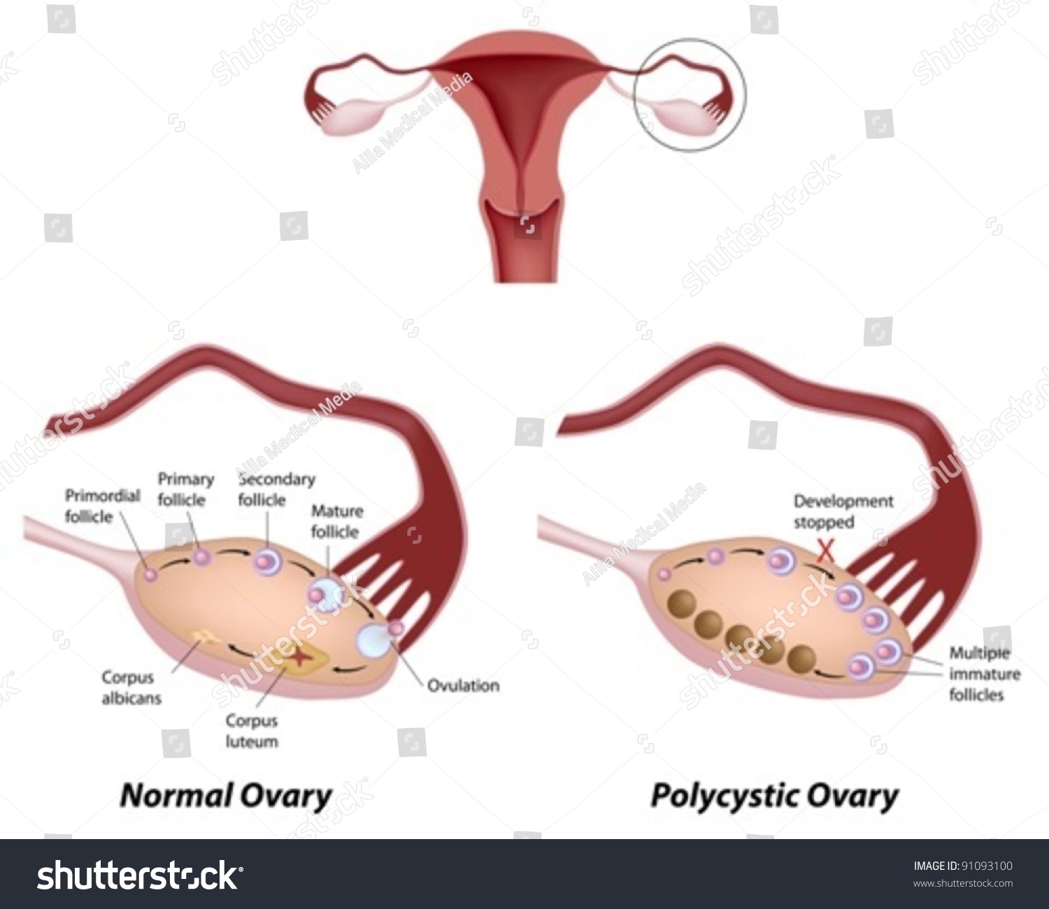 Normal Ovarian Cycle And Polycystic Ovary Syndrome Leading Cause Of Infertility Stock Vector 7914