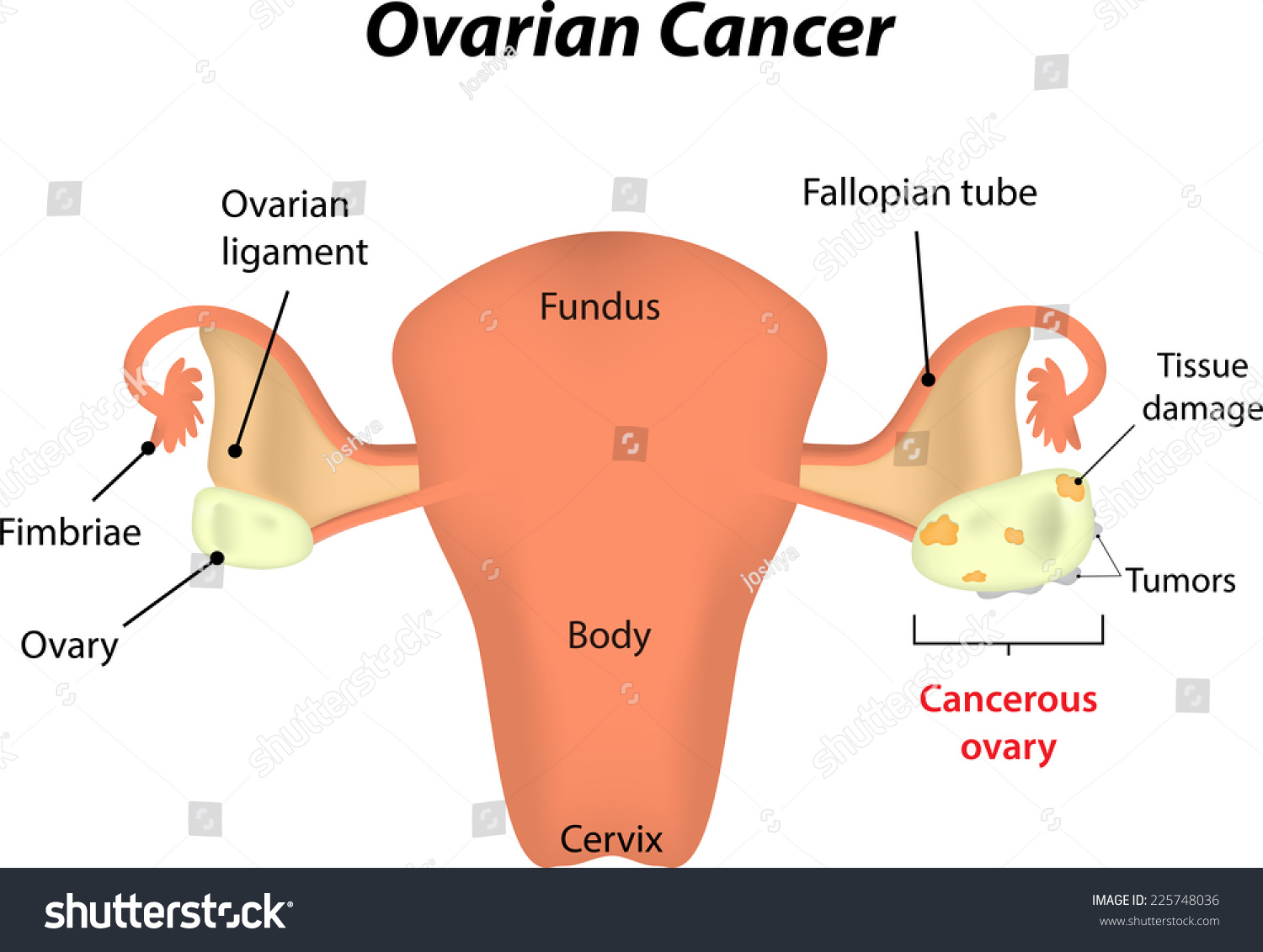 Ovarian Cancer Stock Vector Illustration 225748036 Shutterstock 