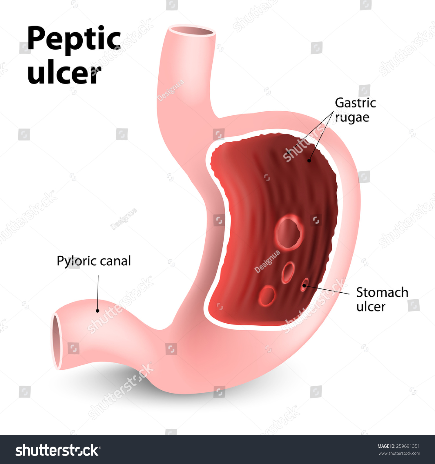 Peptic Ulcer Disease  Pud   Vector Illustration Of Diagram