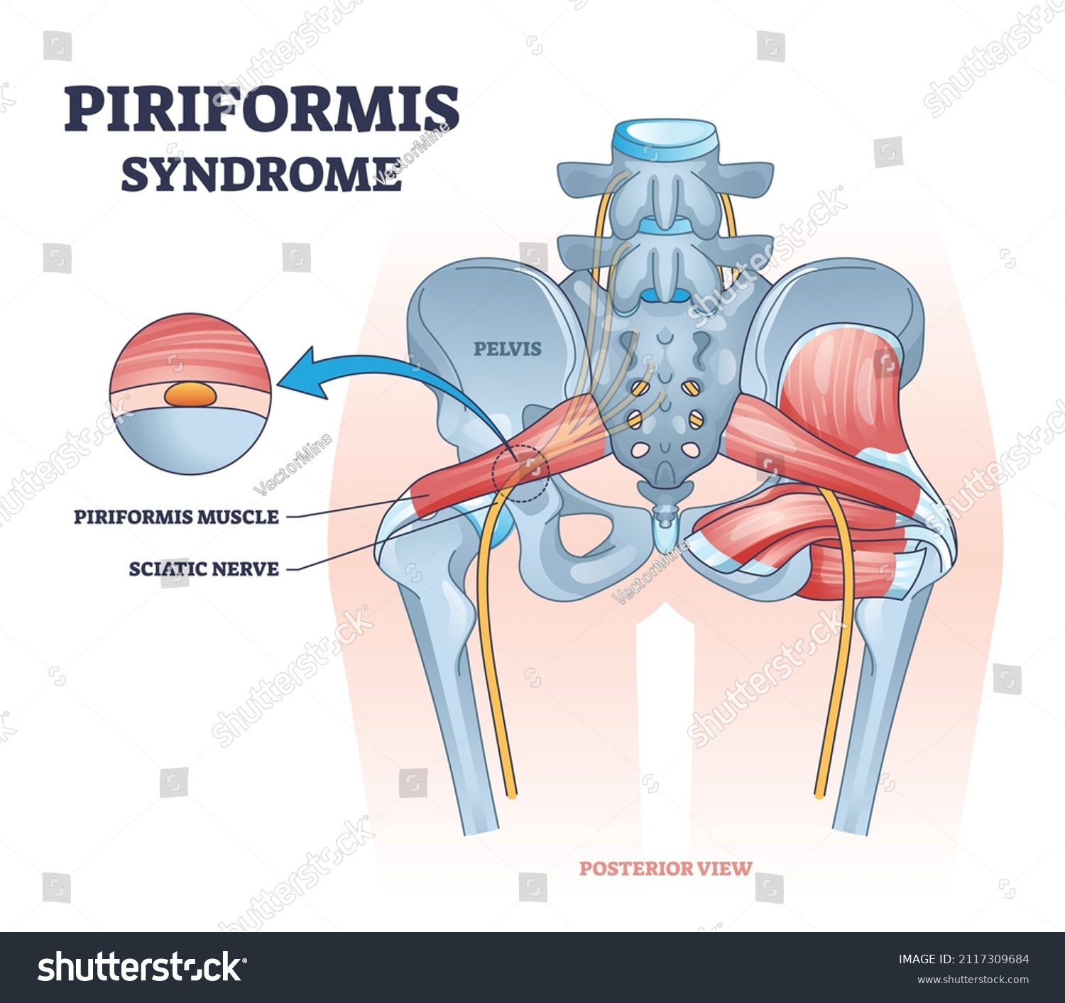 Piriformis Syndrome Sciatic Nerve Compression Pain Stock Vector