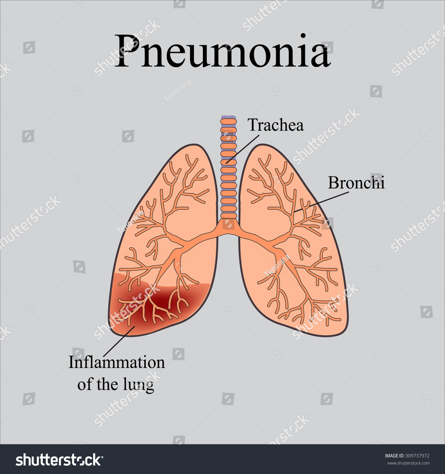 Pneumonia. The Anatomical Structure Of The Human Lung. Vector ...