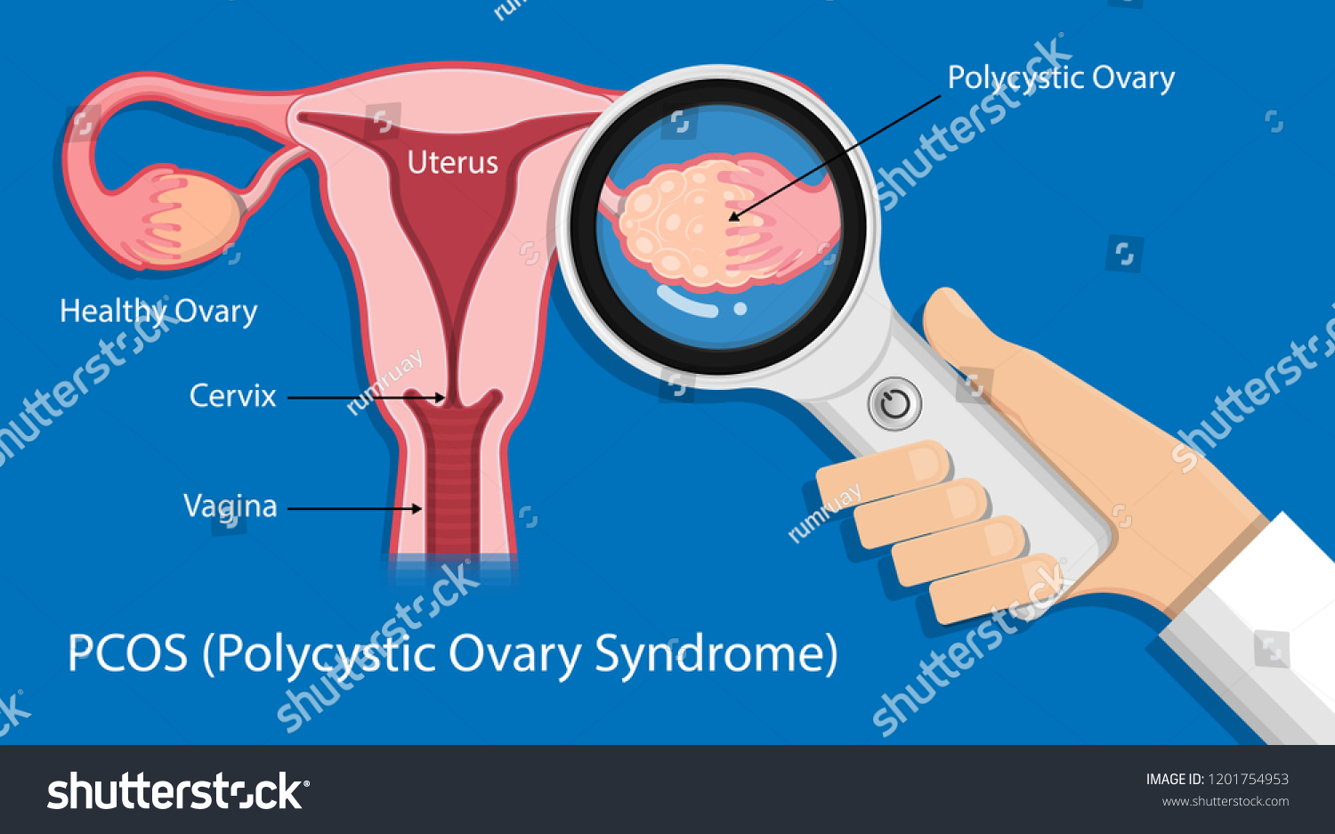 Polycystic Ovary Syndrome Pcos Hormonal Diagnose Stock Vector Royalty