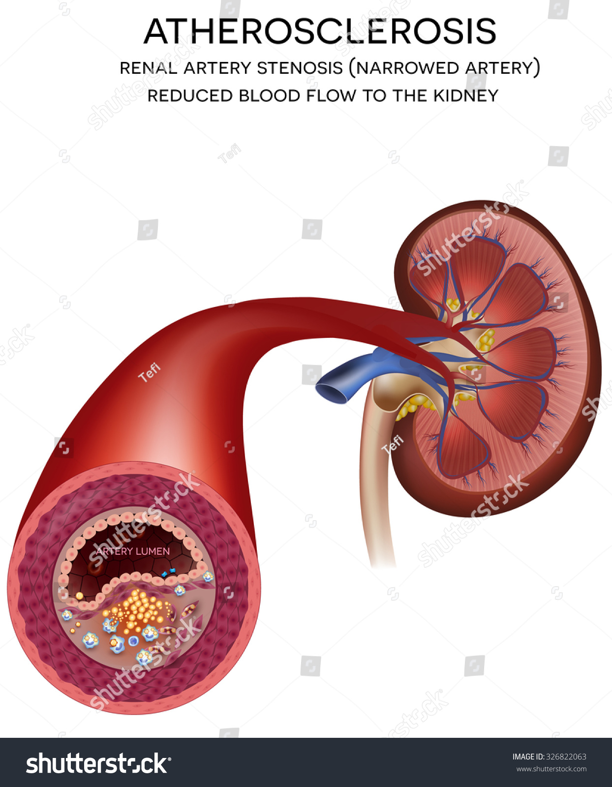 renal-artery-disease-atherosclerosis-progression-at-the-end-blocked