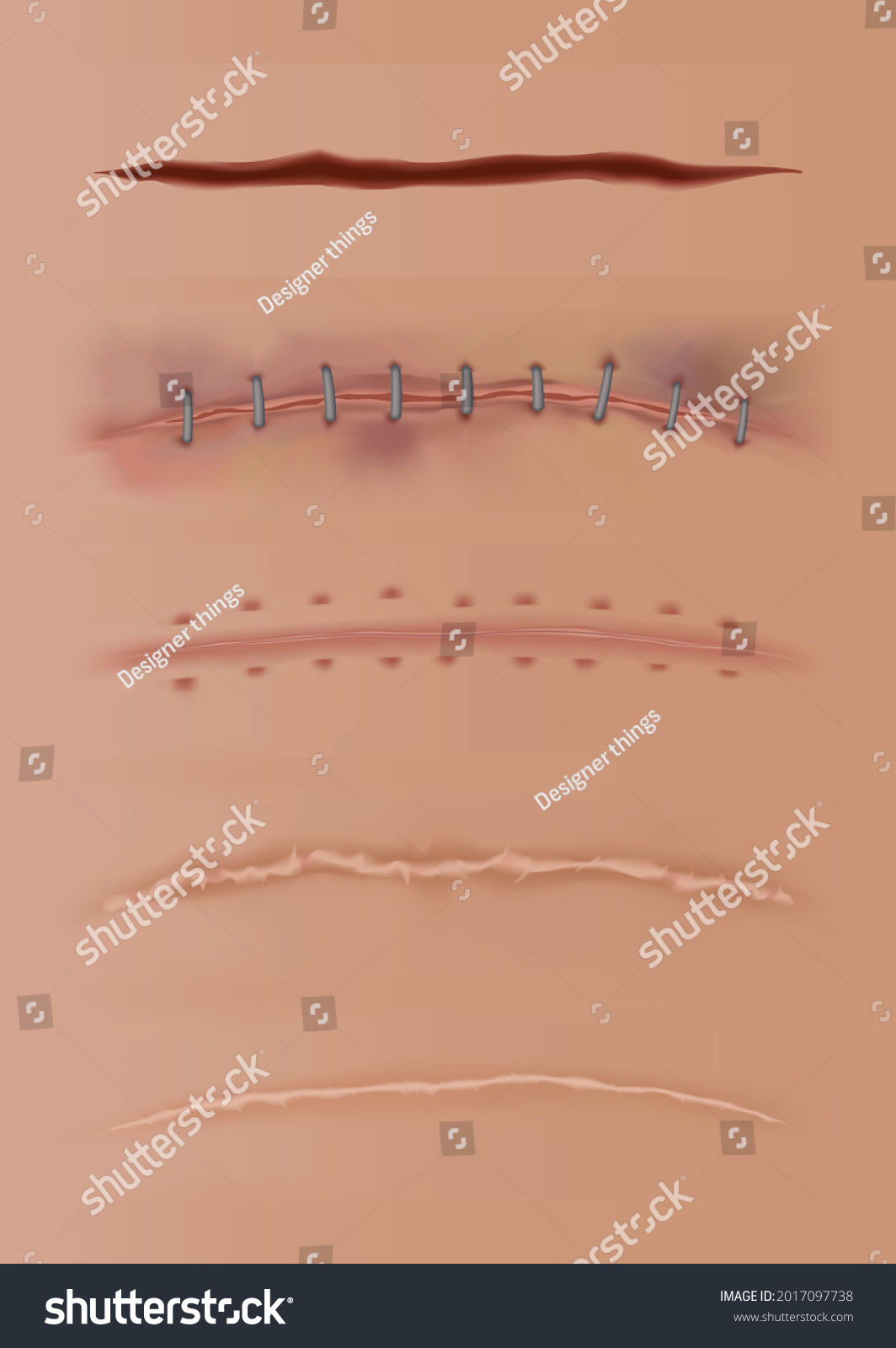 Set Healing Wounds Skin Scars Stitched Stock Vector Royalty Free