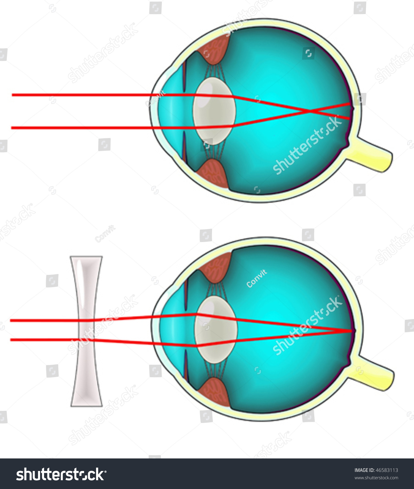 Shortsighted Eye Corrected With A Concave Lens Stock Vector Illustration 46583113 Shutterstock 4941