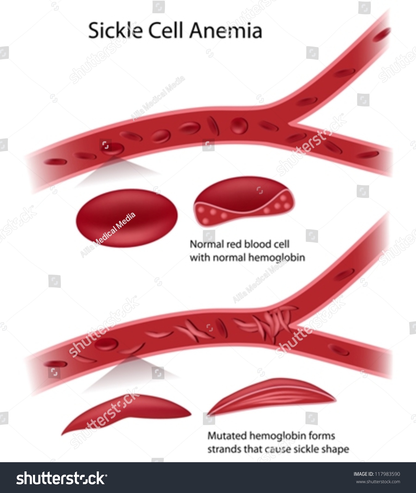 Sickle Cell Disease Stock Vector Illustration 117983590 : Shutterstock