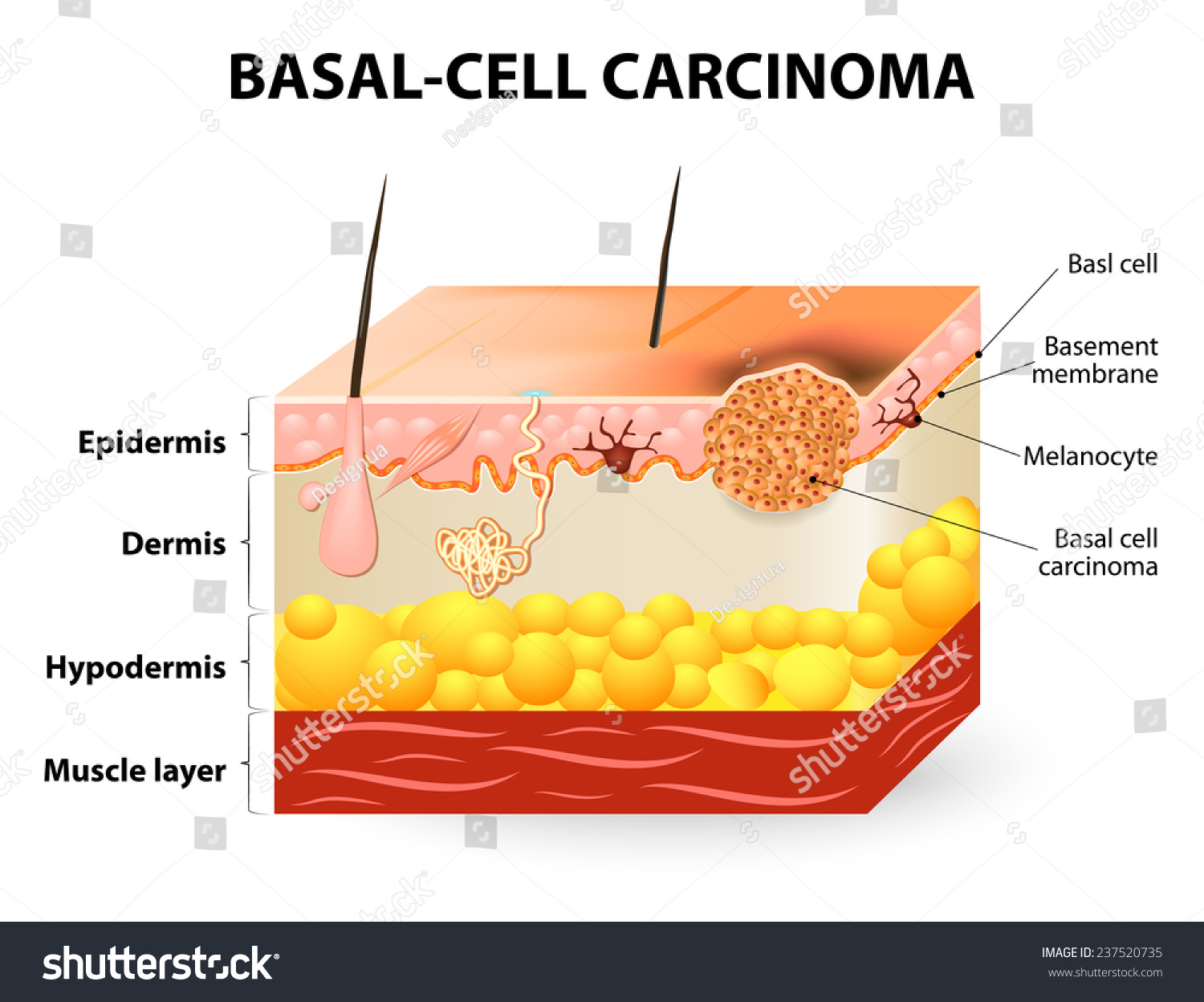 Skin Cancer: Basal and Squamous Cell Overview