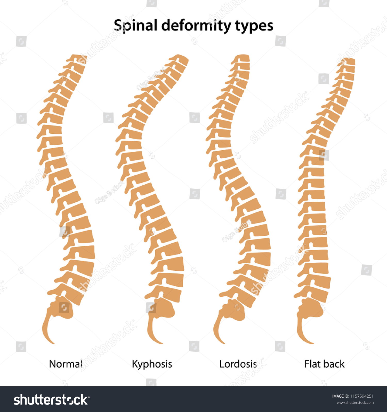 Spinal Deformity Types Vector Illustration Vector De Stock Libre De