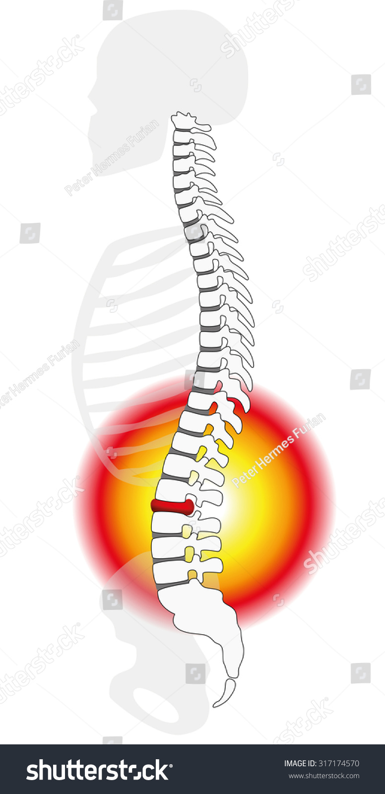 Spinal Disc Herniation Prolapse Human Vertebral Stock Vektor