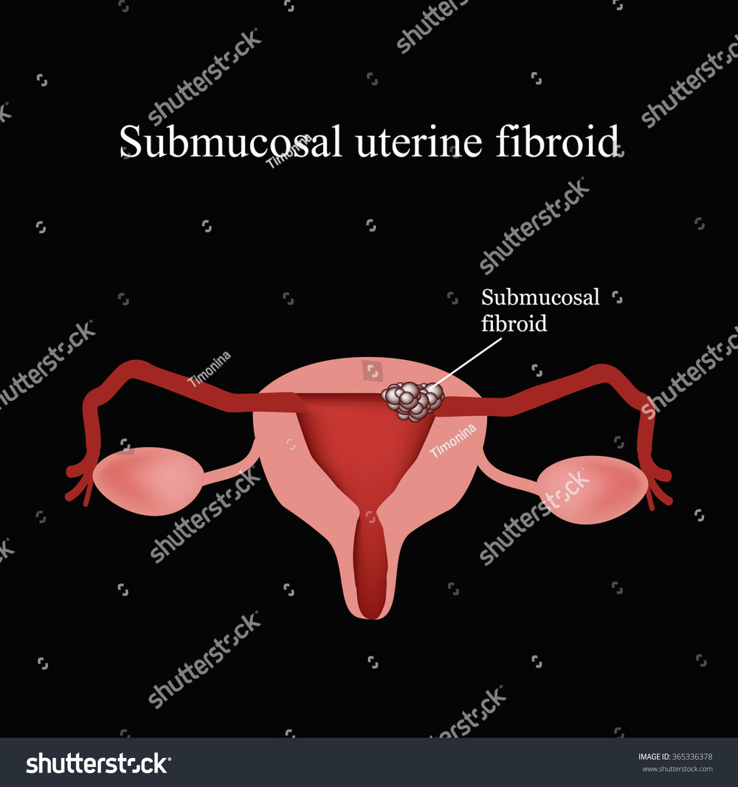 Submucosal Fibroids Endometriosis Infographics Vector Illustration Stock Vector 365336378 