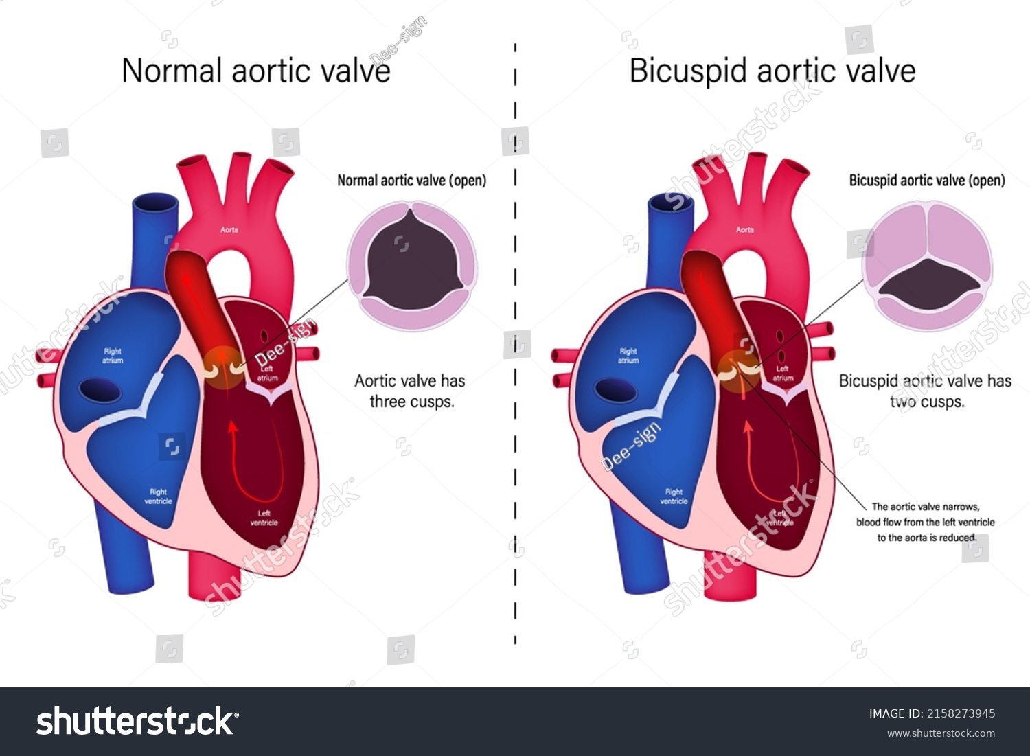 Difference Normal Heart Valve Bicuspid Aortic Stock Vector Royalty