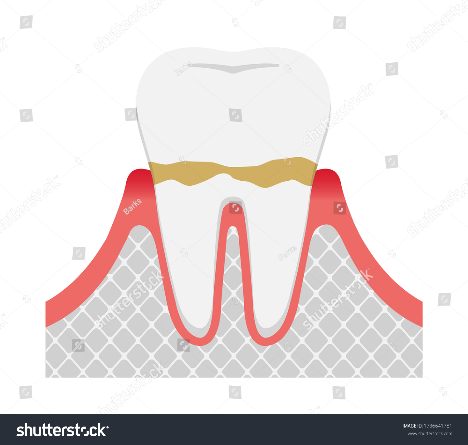 Vektor Stok Stages Periodontitis Disease Gingivitis Tanpa Royalti