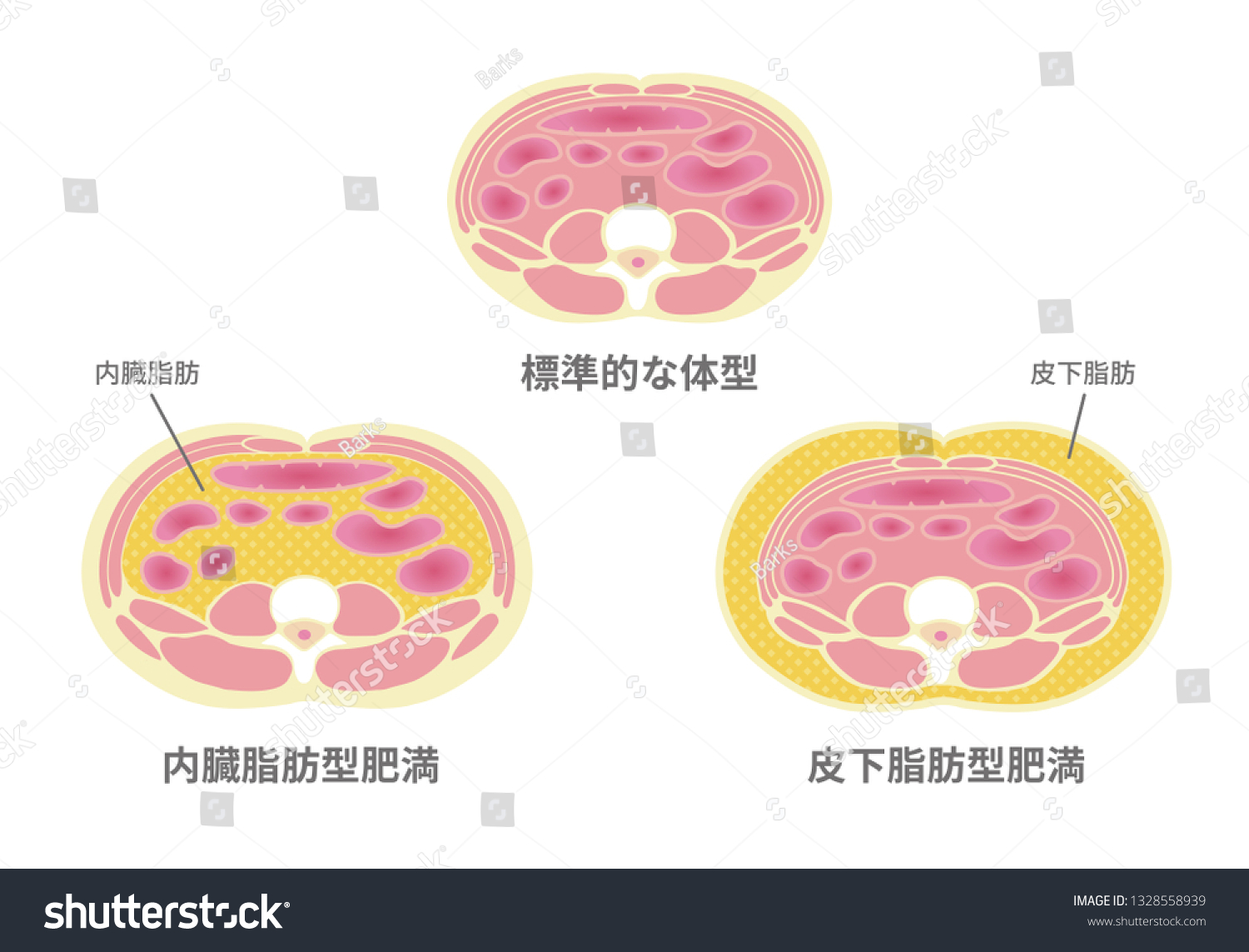 Type Obesity Illustration Japanese Abdominal Sectional Stock Vector