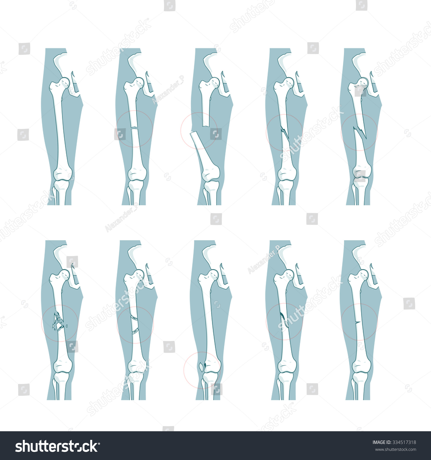 Types Bone Fractures Medical Skeleton Anatomy Vector De Stock Libre