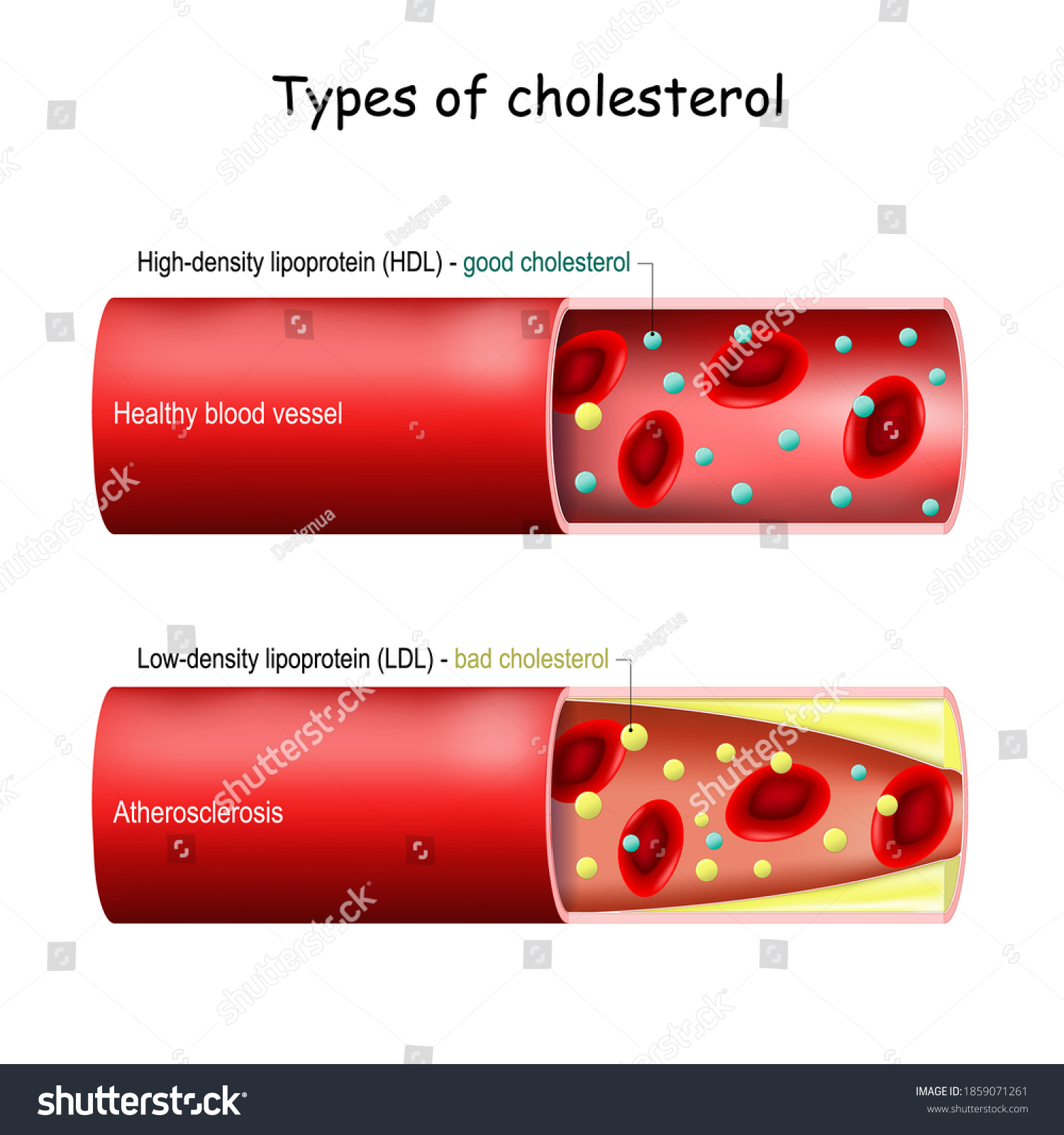 Types Cholesterol Good Hdl Bad Ldl Vetor Stock Livre De Direitos