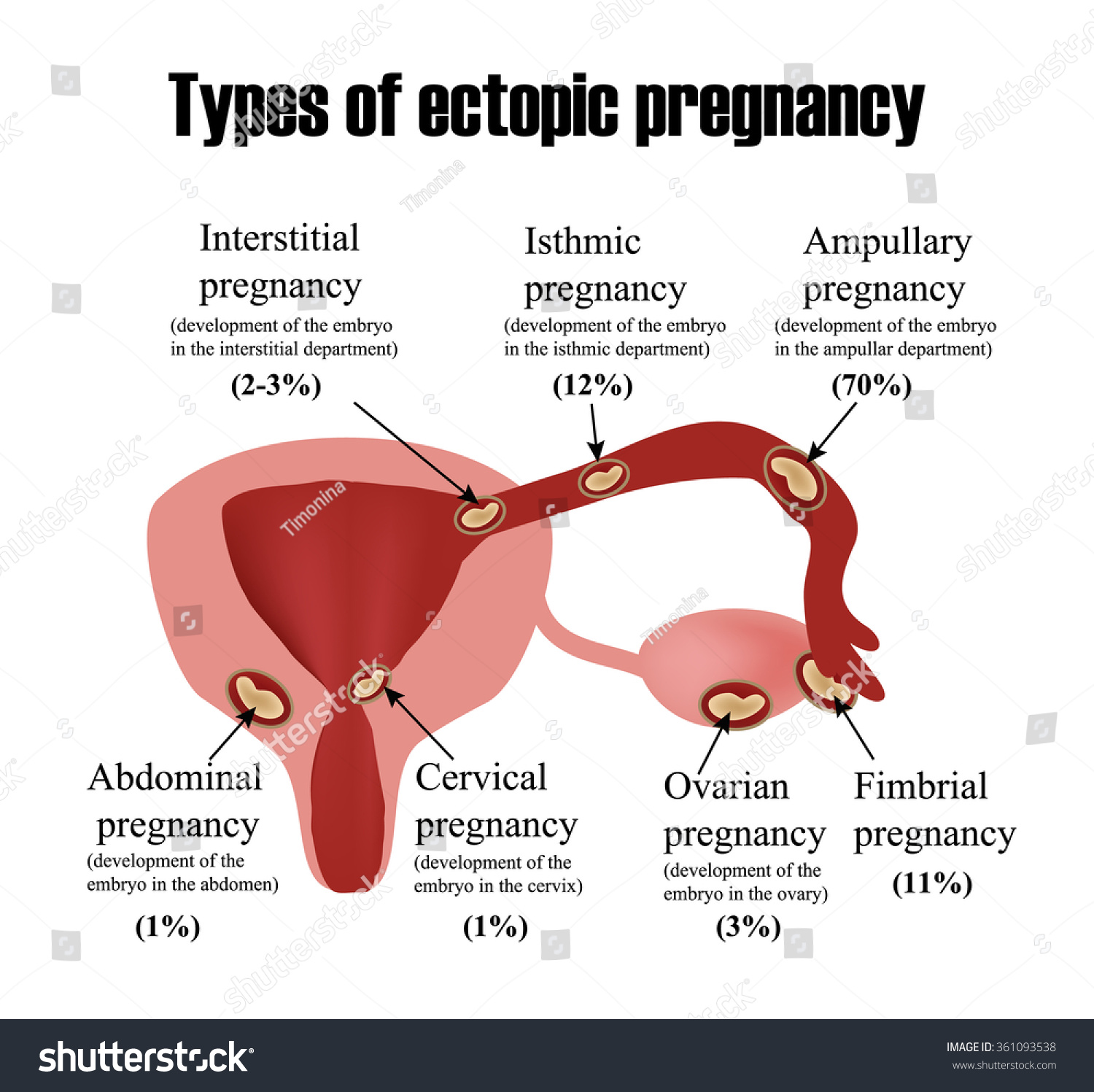 Types Ectopic Pregnancy Infographics Vector Illustration 库存矢量图免版税