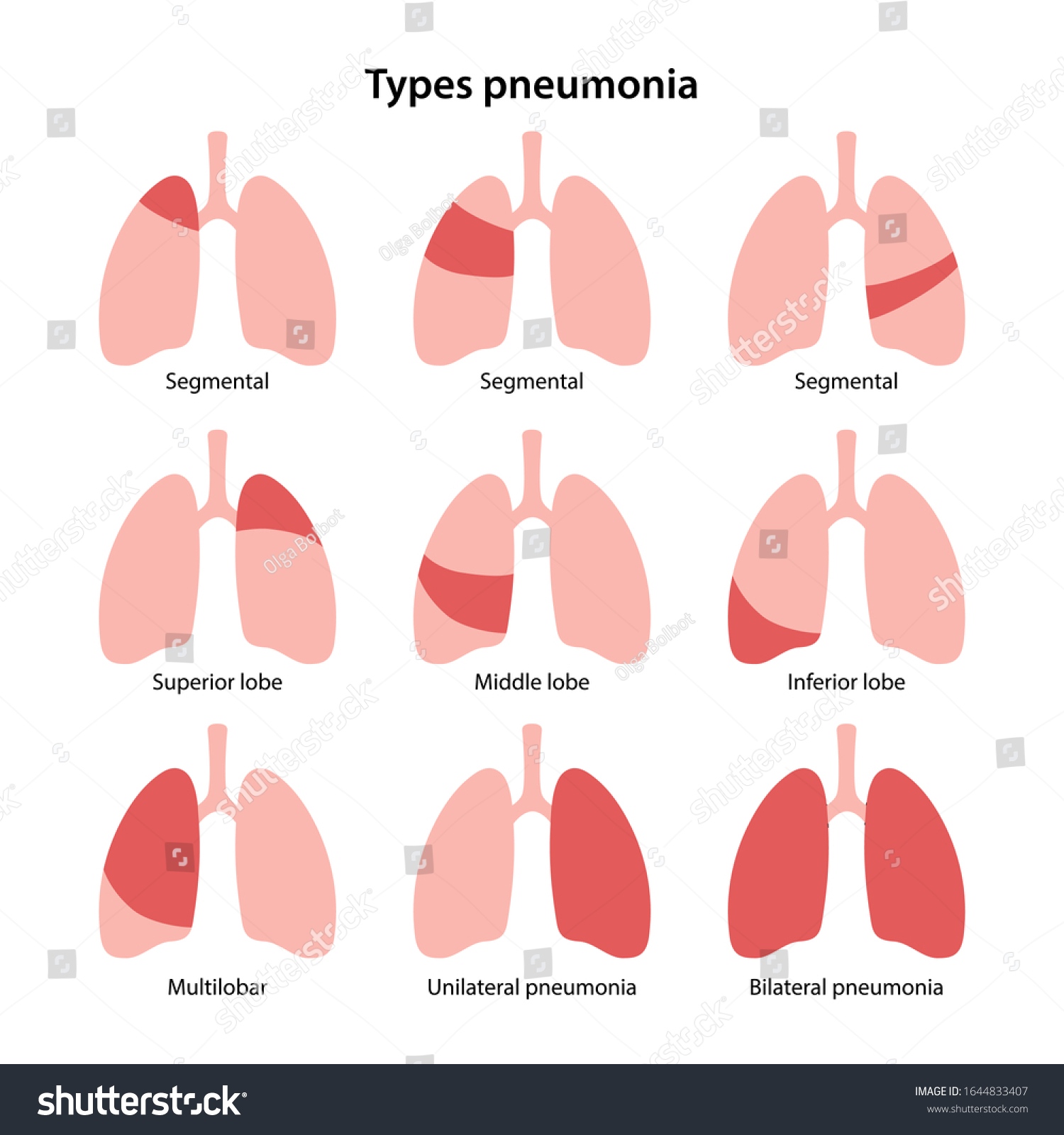 Unilateral Pneumonia 4 Images Photos Et Images Vectorielles De Stock