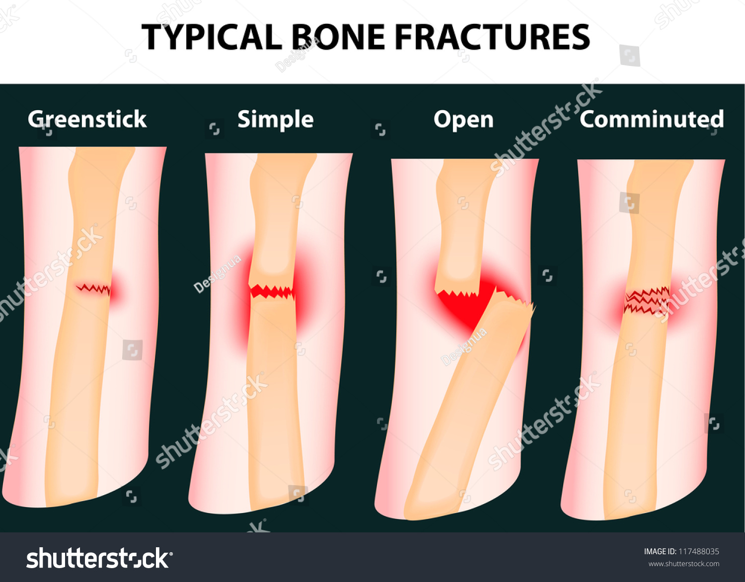 Typical Bone Fractures Vector Scheme 117488035 Shutterstock 7109