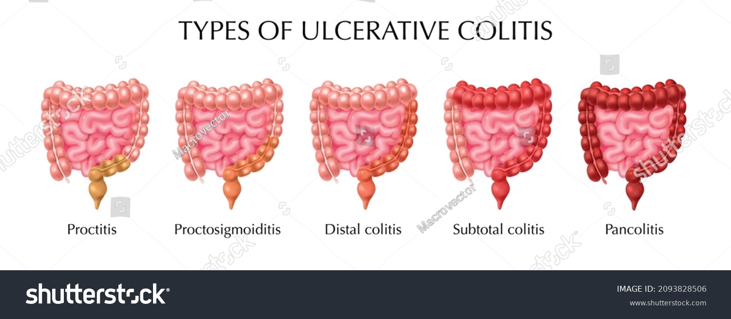 Ulcerative Colitis Types Infographics Including Proctitis Stock Vector