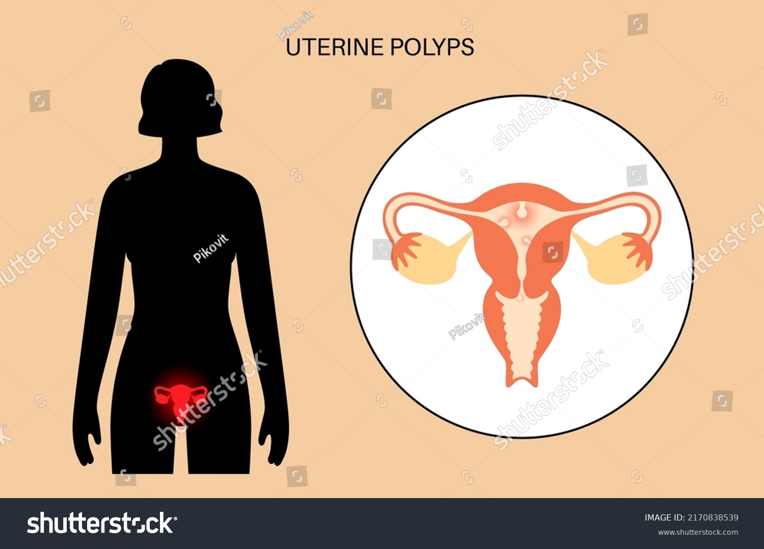 Uterine Polyps Anatomy Endometrial Disease Overgrowth Stock Vector