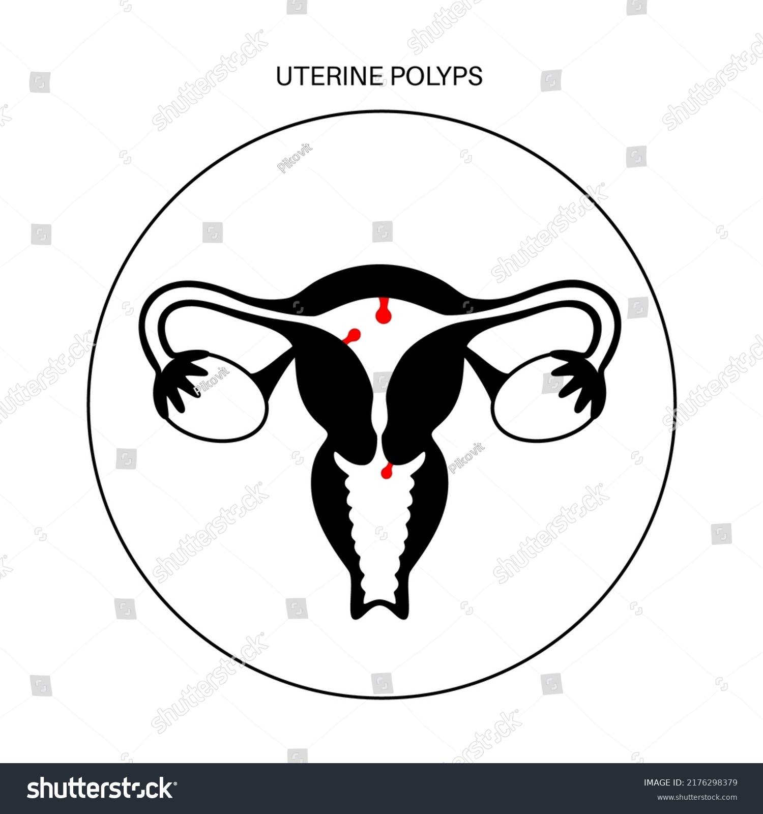 Uterine Polyps Anatomy Endometrial Disease Overgrowth Stock Vector