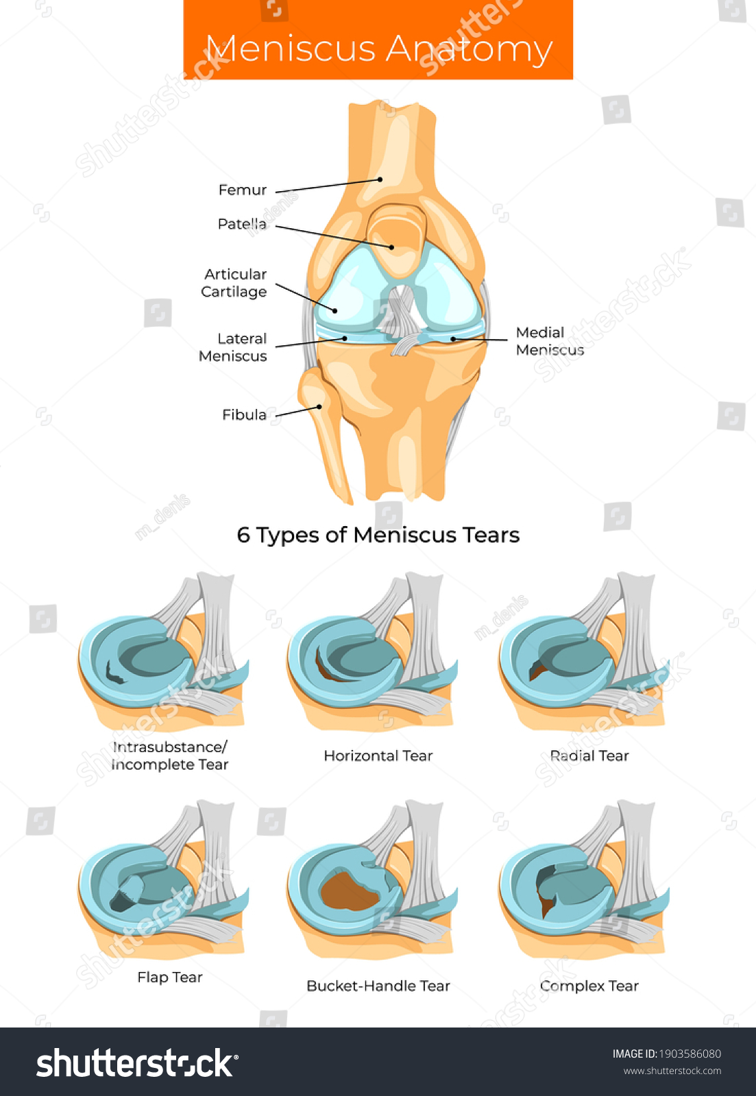 Vector Illustration Meniscus Anatomy Types Stock Vector Royalty Free