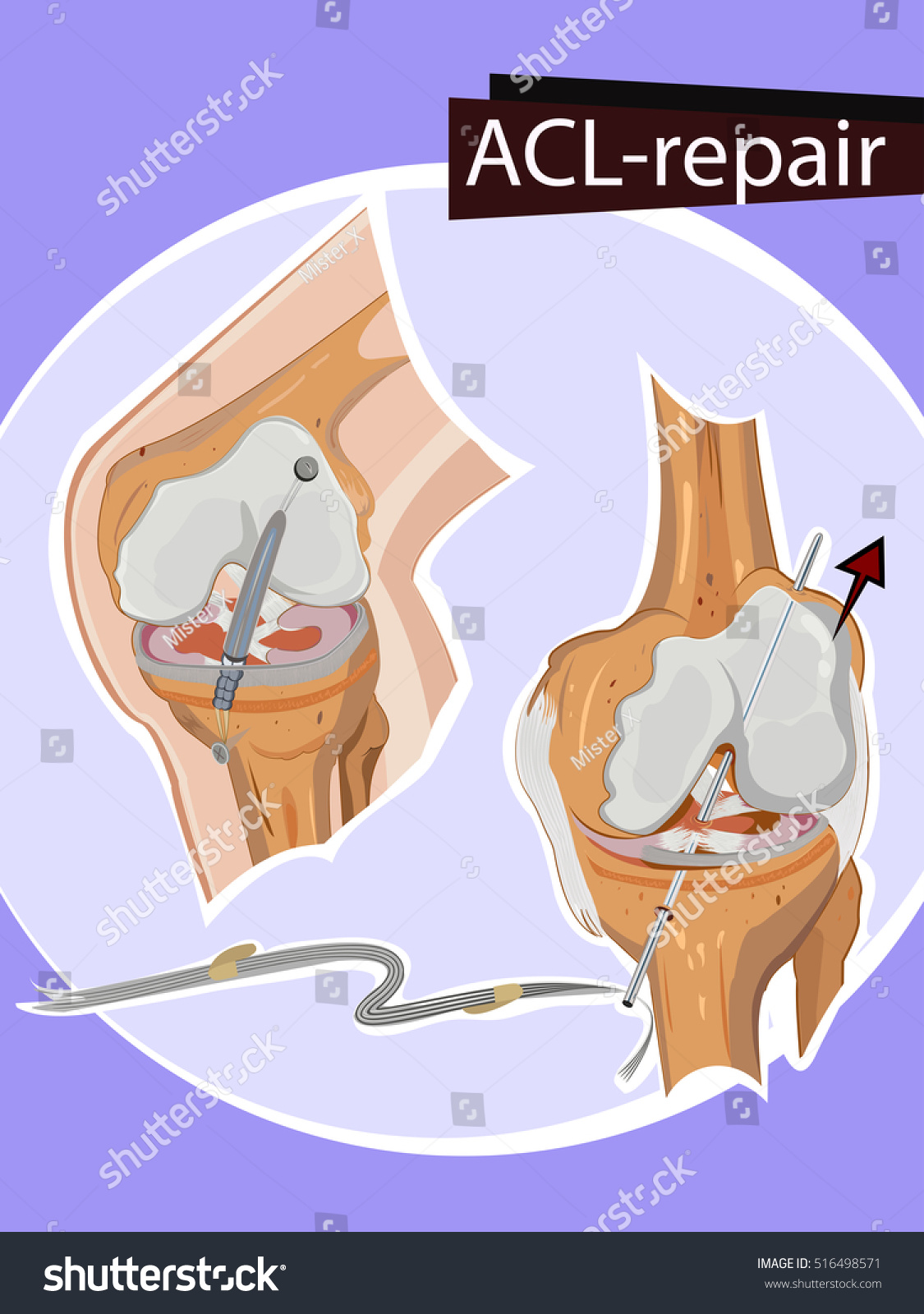 Vector Illustration Of Knee Repair - 516498571 : Shutterstock