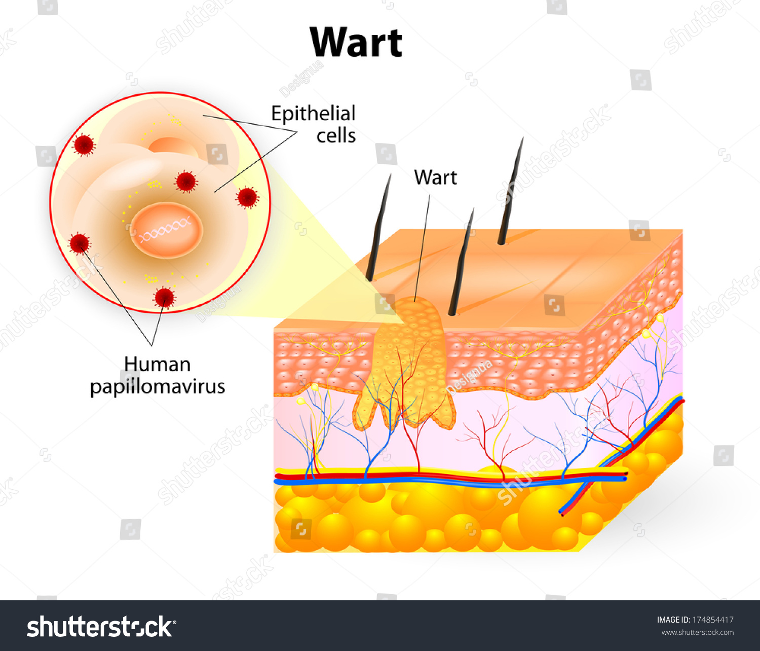 Wart Anatomy. Warts Are Benign Skin Growths That Appear When A Human