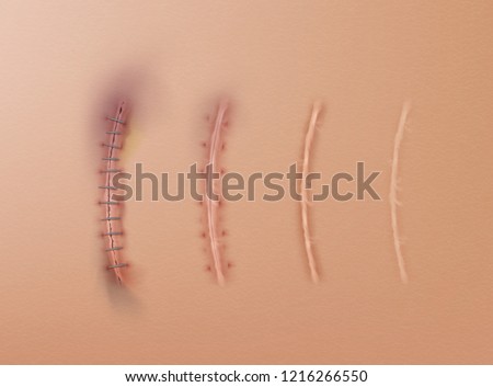 Vector realistic set of surgical sutures and scars, stitched wounds at different healing stages isolated on skin background Imagine de stoc © 