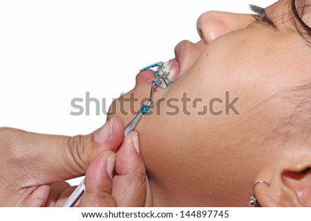 young woman amid dental surgery or braces treatment is done by a dental surgeon isolated on white background