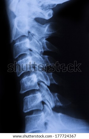 side view X Ray of the cervical spine