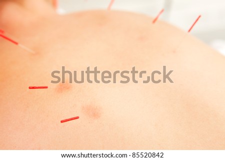 Detail of acupuncture needles inserted in the first Urinary Bladder Channel Line (Shu Points).  Redness around needles points shows good responsivness to treatment