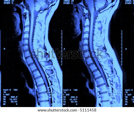 MRI Cervical Spine
