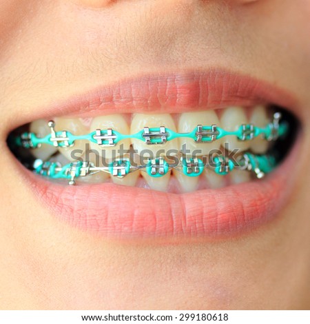 Closeup Asian women Ceramic and Metal Braces on Teeth.Smile with Sapphire braces.