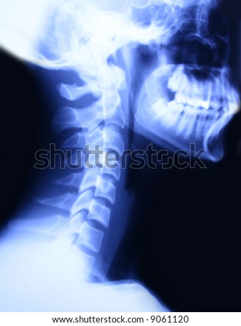 X-ray of a head and neck