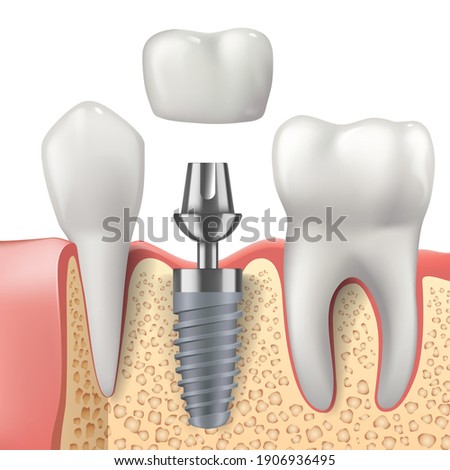 Teeth and dental implant realistic vector design of dentistry. 3d tooth, denture crown, jaw bones and healthy roots, implant screw and abutment, healthcare, dentist and orthodontist treatment