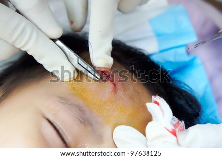 Doctor stitch closing a wound in the forehead during surgery