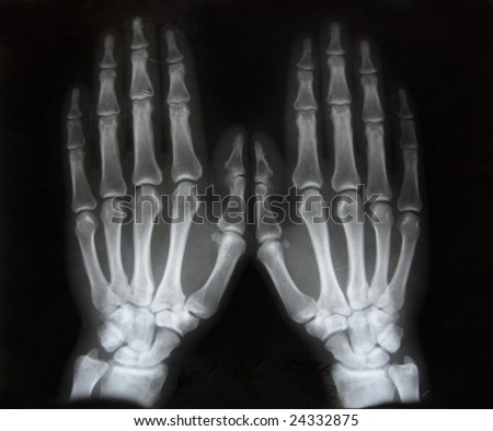 black and white photo of x-ray picture  of human hands