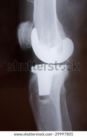 Total knee replacement side x-ray picture