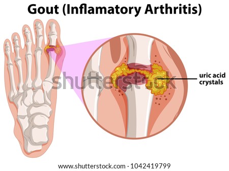 Diagram showing gout in human foot illustration