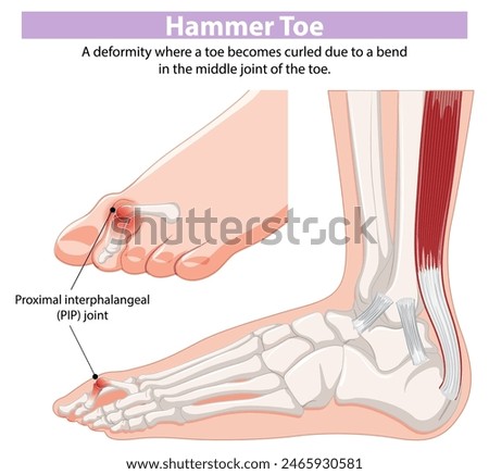 Diagram showing hammer toe deformity and PIP joint