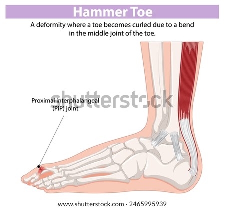 Diagram showing hammer toe and PIP joint
