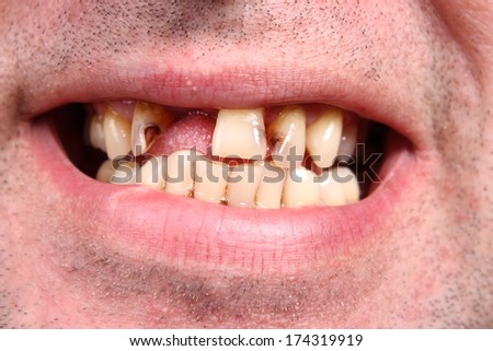 Bad teeth, smoker