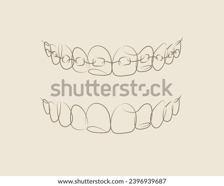 Jaws with and without braces installed drawing in linear style on beige background