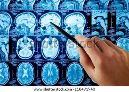 magnetic resonance image (MRI) of the brain