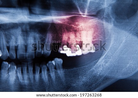Panoramic dental dentist X-Ray with hands point in Computer screen and film