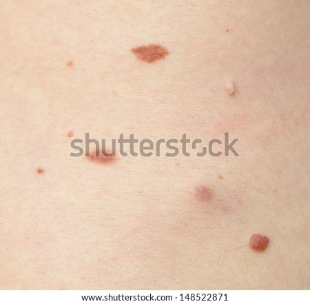 Moles and various skin conditions macro