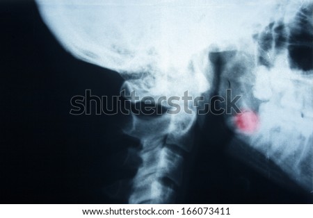 X-ray human skull  basis and bottom jaw. Problem with a wisdom tooth