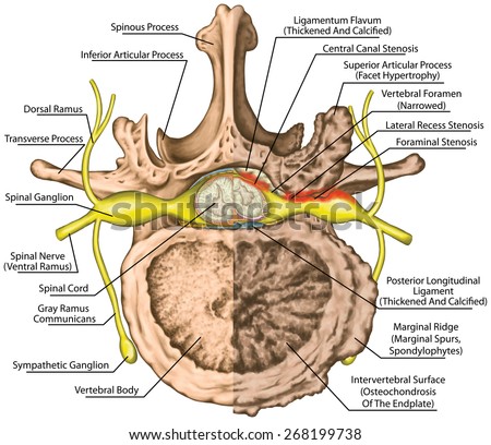 Stenosis, Central Lateral Stenosis,Nervous System, Spinal Cord, Lumbar ...