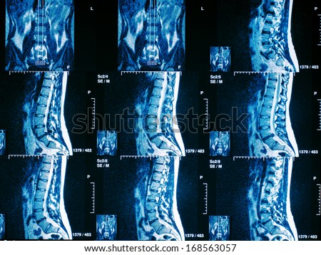 Magnetic resonance imaging of human spine (Discus Hernia)